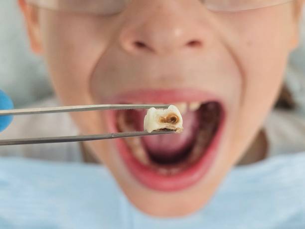 Best Emergency Treatment for Dental Infections or Abscesses in North Eagle Butte, SD